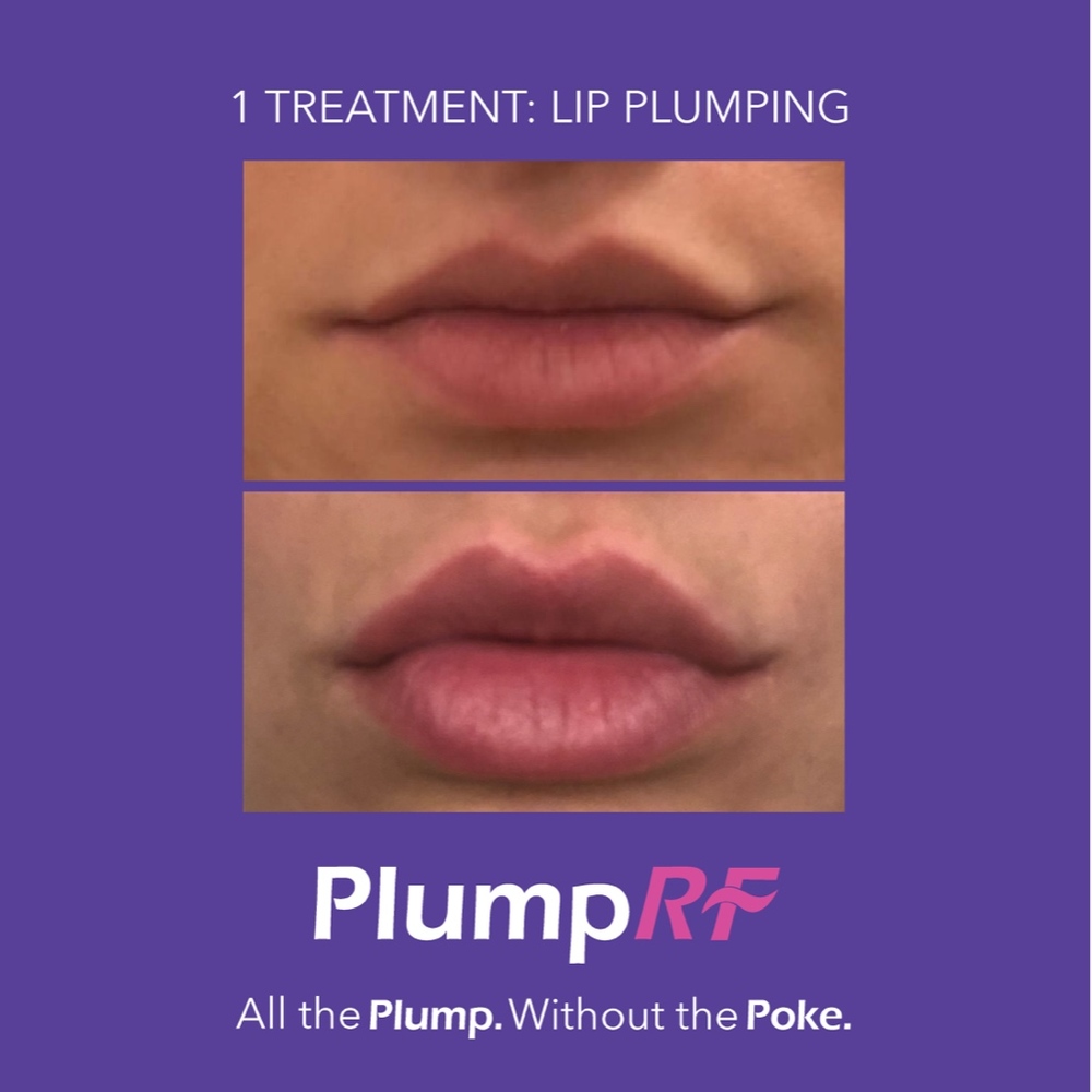 Radio Frequency Lip Plumping